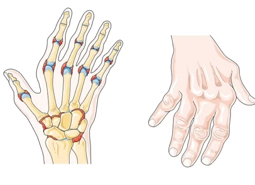 4 stages of rheumatoid arthritis