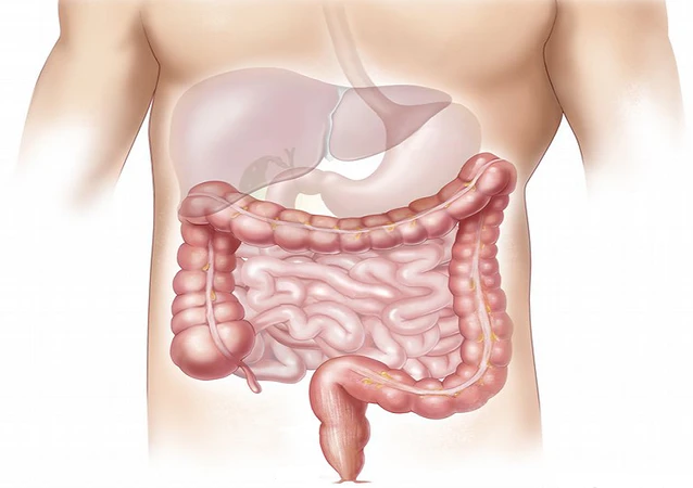 living with Ulcerative Colitis